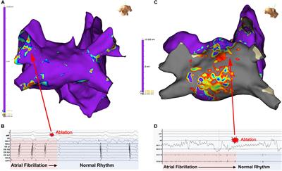 Linking Electrical Drivers With Atrial Cardiomyopathy for the Targeted Treatment of Atrial Fibrillation